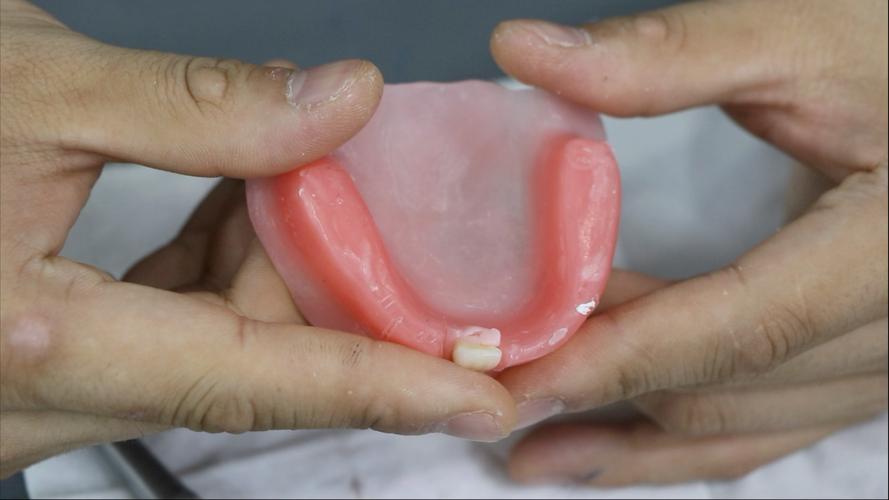 全口义齿修复的最佳方法是什么?-图2 全口义齿修复的最佳方法是什么?-图2