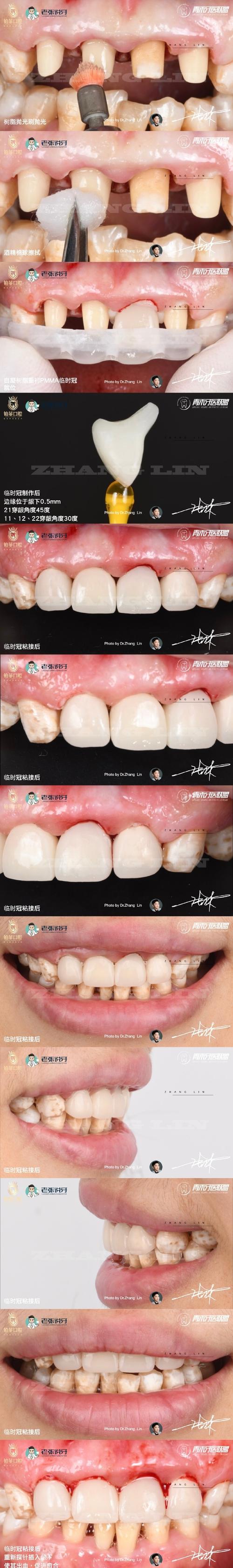 前牙贴面的预备方法-图3