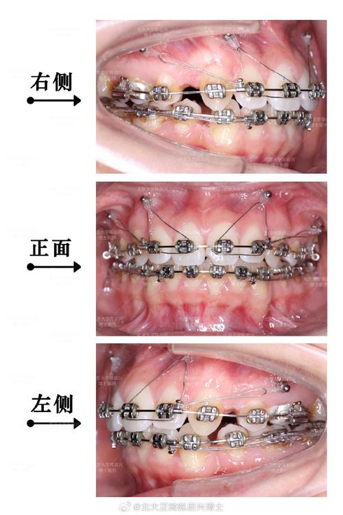 正畸种植钉植入方法的关键步骤与操作技巧是什么？-图3