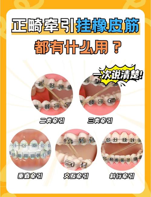 正畸后什么时候戴皮筋？戴多久合适？-图1