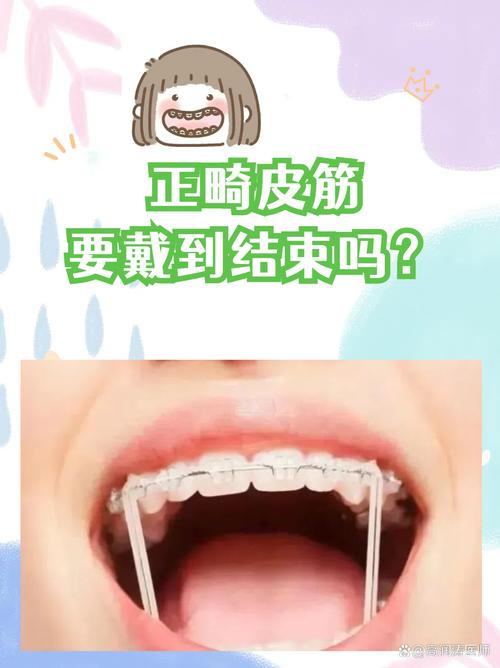 正畸后什么时候戴皮筋？戴多久合适？-图2