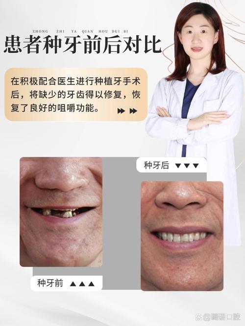 牙齿高了不能种牙，究竟是为什么？-图3