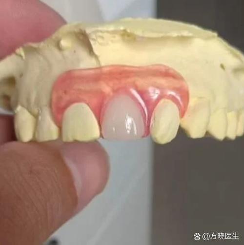 种牙牙冠为什么会掉出来？是什么原因导致的？该怎么办？-图2