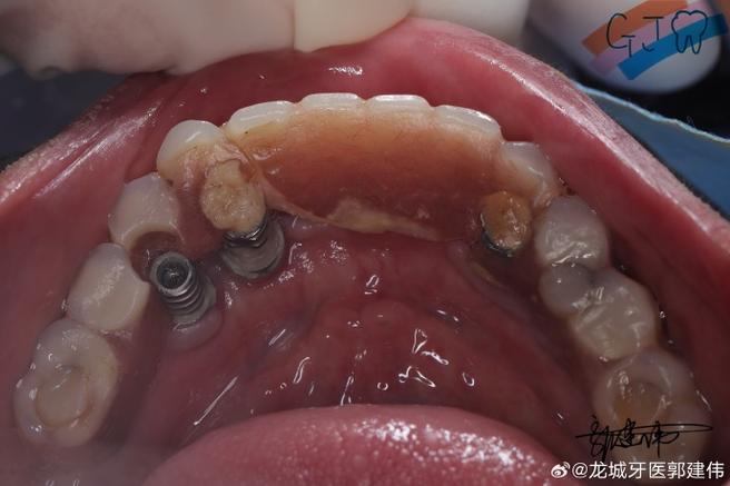 种牙牙冠为什么会掉出来？是什么原因导致的？该怎么办？-图3