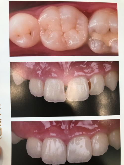 树脂修复怎么治？效果和注意事项有哪些？-图1