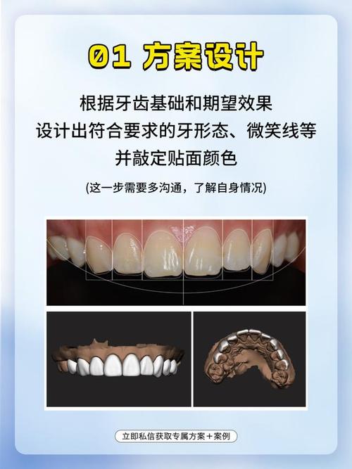 牙贴面真有100种做法?哪种最适合你?-图1 牙贴面真有100种做法?哪种最适合你?-图1