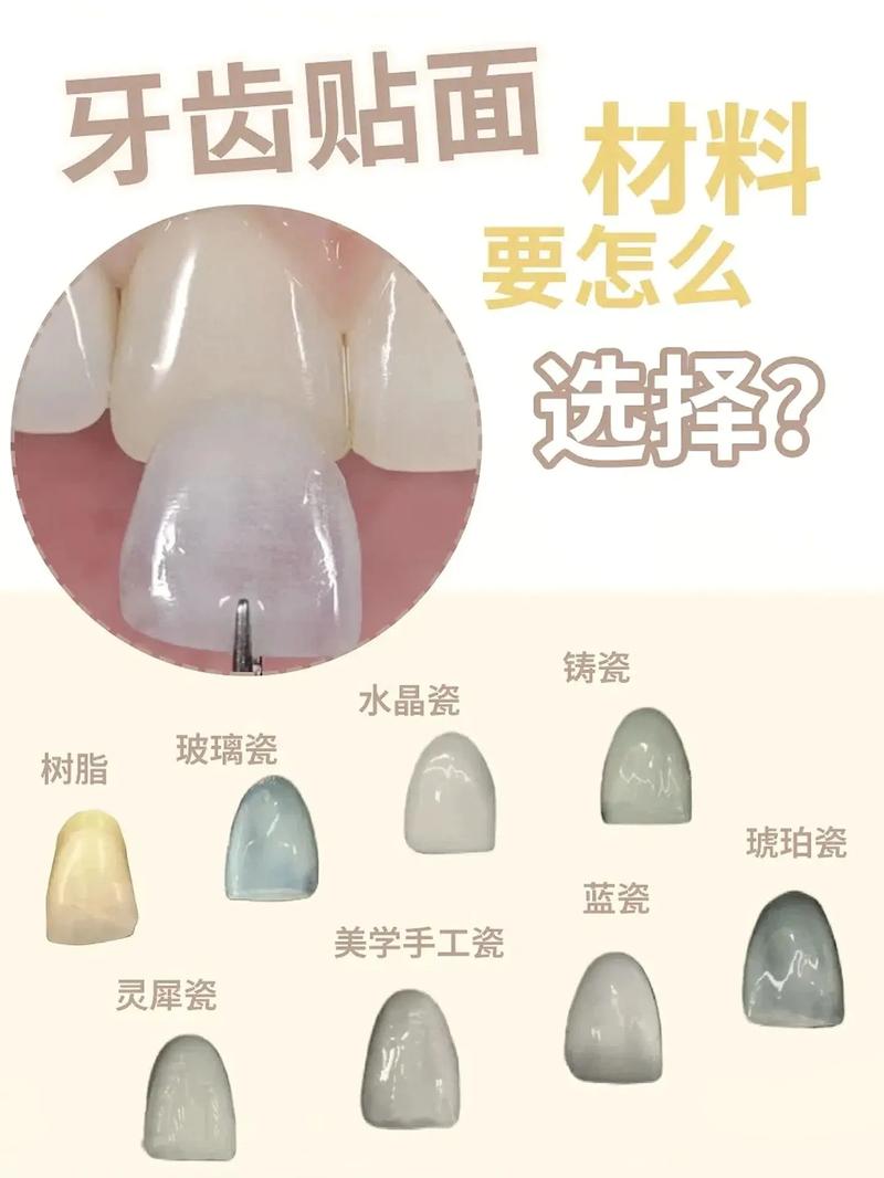牙贴面真有100种做法？哪种最适合你？-图2