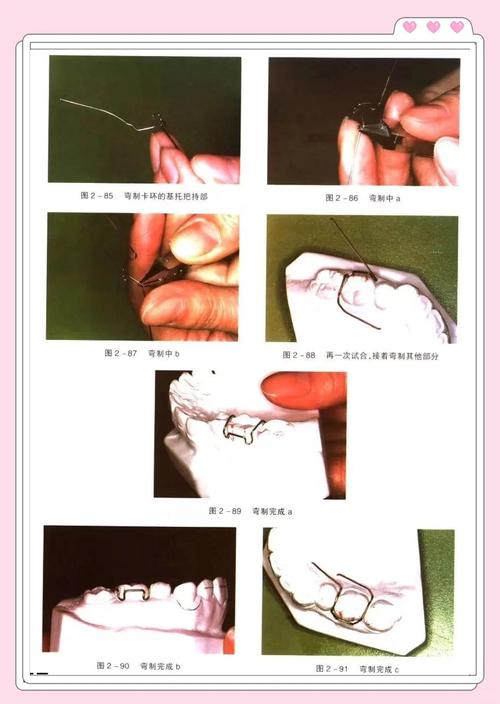 正畸结扎丝方法图解，如何通过图解掌握正确操作步骤？-图3