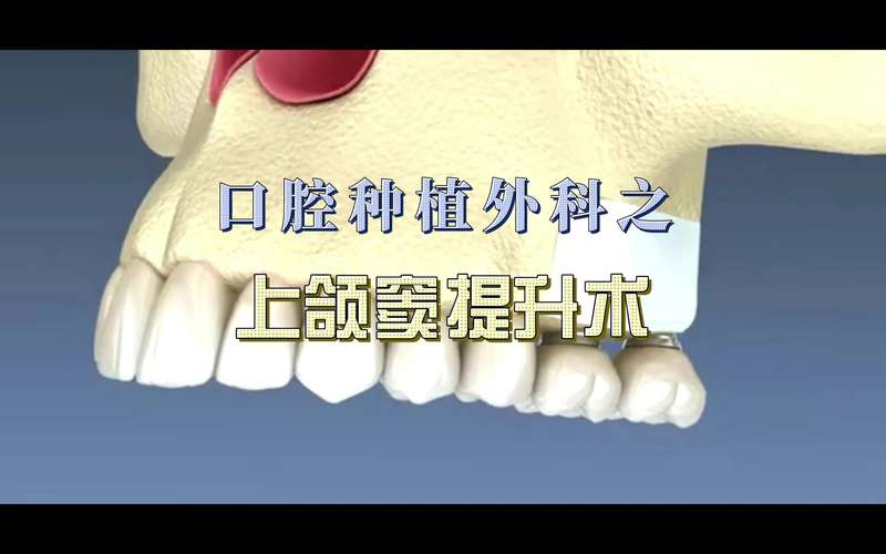 上额窦提升方法包括哪些？常见术式与应用选择？-图2