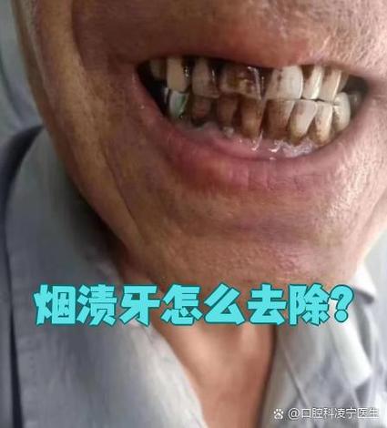 吸烟导致 种牙失败-图2