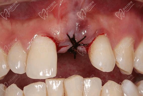 种牙拆线后牙疼，是什么原因？是否正常？-图1