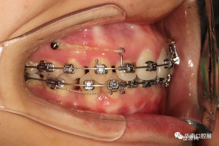 正畸被动结扎的方法如何操作?步骤与要点解析-图3 正畸被动结扎的方法如何操作?步骤与要点解析-图3