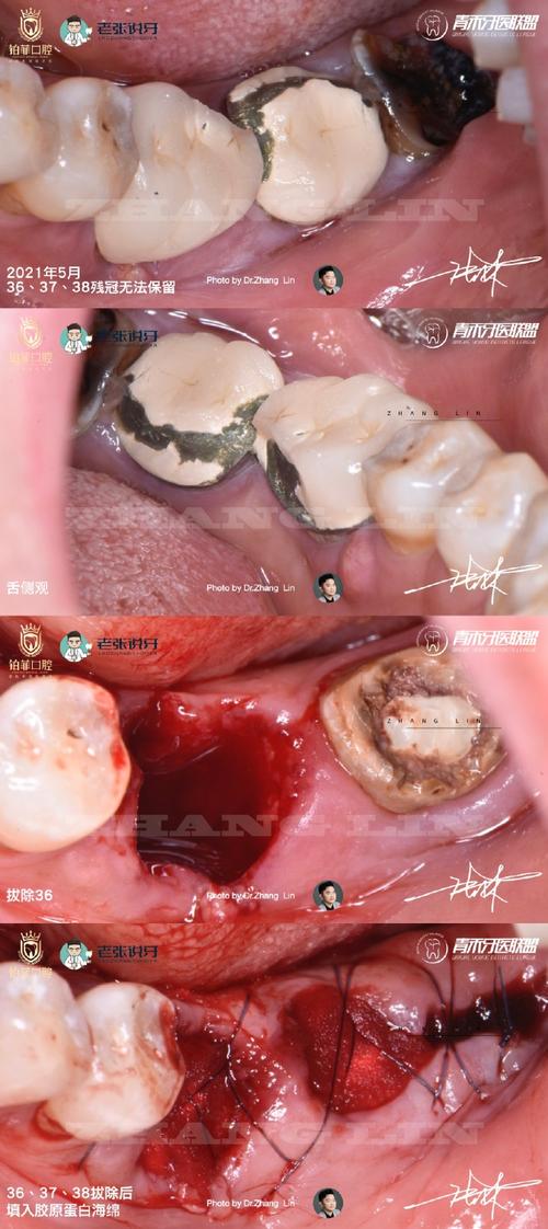 拔牙很久后种牙，会有哪些影响和注意事项？-图2