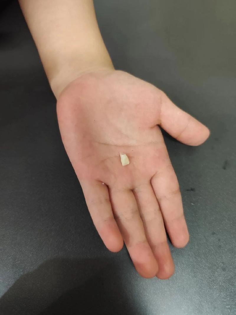 种牙 临时帽子掉了-图2 种牙 临时帽子掉了-图2