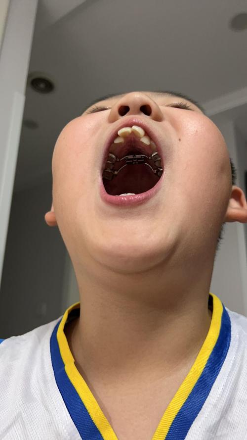 正畸扩弓过度会有哪些不良影响？-图1