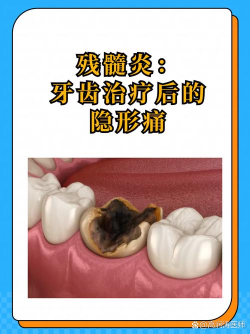 残髓用什么方法处理-图2 残髓用什么方法处理-图2