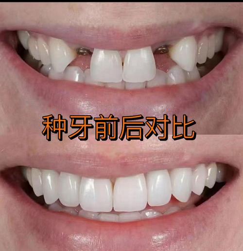 种植牙和真牙哪个更好?从使用体验、耐用性到维护成本全面对比-图1 种植牙和真牙哪个更好?从使用体验、耐用性到维护成本全面对比-图1
