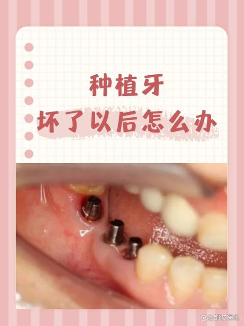 没有牙槽骨种牙怎么办？有哪些可行解决方法？-图3