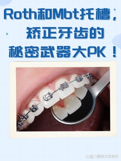 西湖巴尔正畸牙托效果如何？-图1