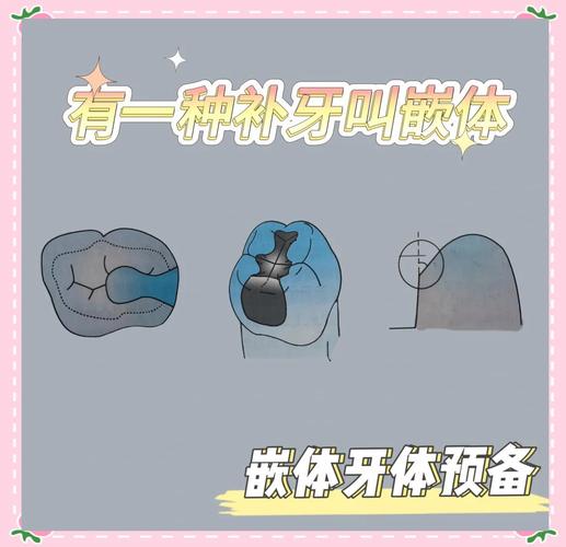 口腔嵌体制备方法的关键步骤与技巧有哪些？-图2