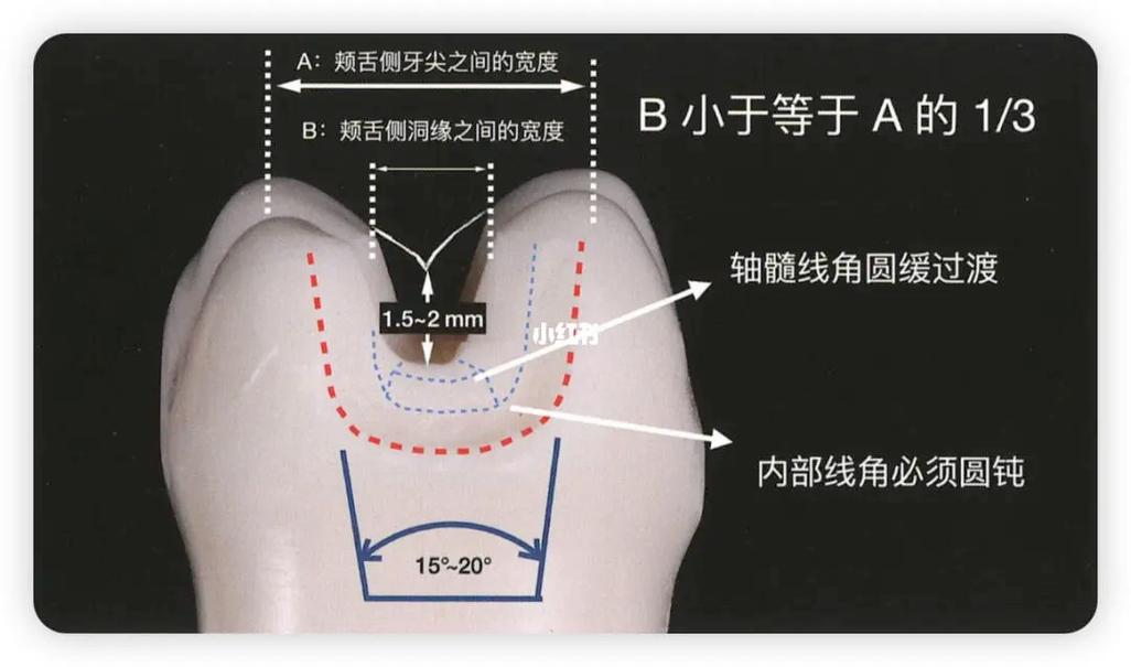 口腔嵌体制备方法的关键步骤与技巧有哪些?-图1 口腔嵌体制备方法的关键步骤与技巧有哪些?-图1