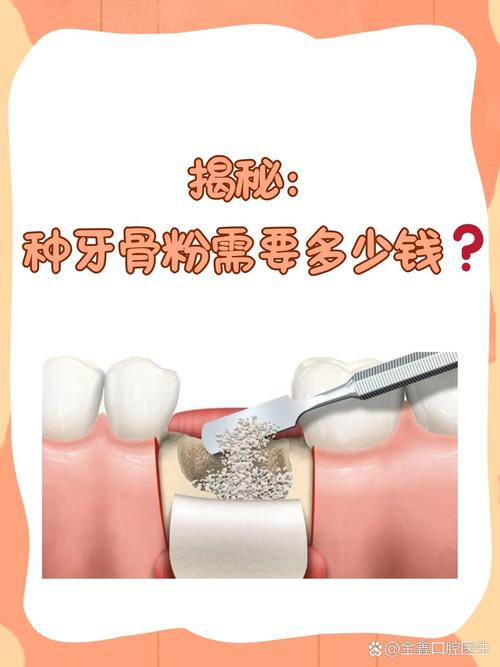 牙槽骨厚度多少毫米适合种牙？-图2