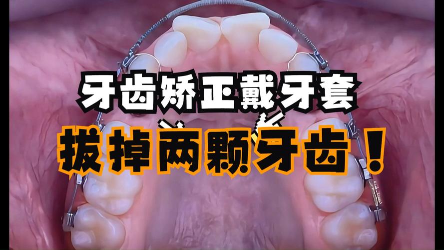 正畸牙齿能不能拔大牙-图2