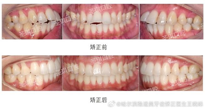 开颌手术VS正畸,选哪个更优?效果、风险、适用情况如何权衡?-图1 开颌手术VS正畸,选哪个更优?效果、风险、适用情况如何权衡?-图1