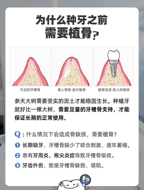 植骨手术后通常需要等待多长时间才能成功种牙?-图1 植骨手术后通常需要等待多长时间才能成功种牙?-图1