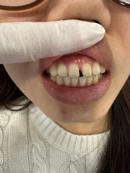 牙缝大修复该挂正畸科吗?-图3 牙缝大修复该挂正畸科吗?-图3