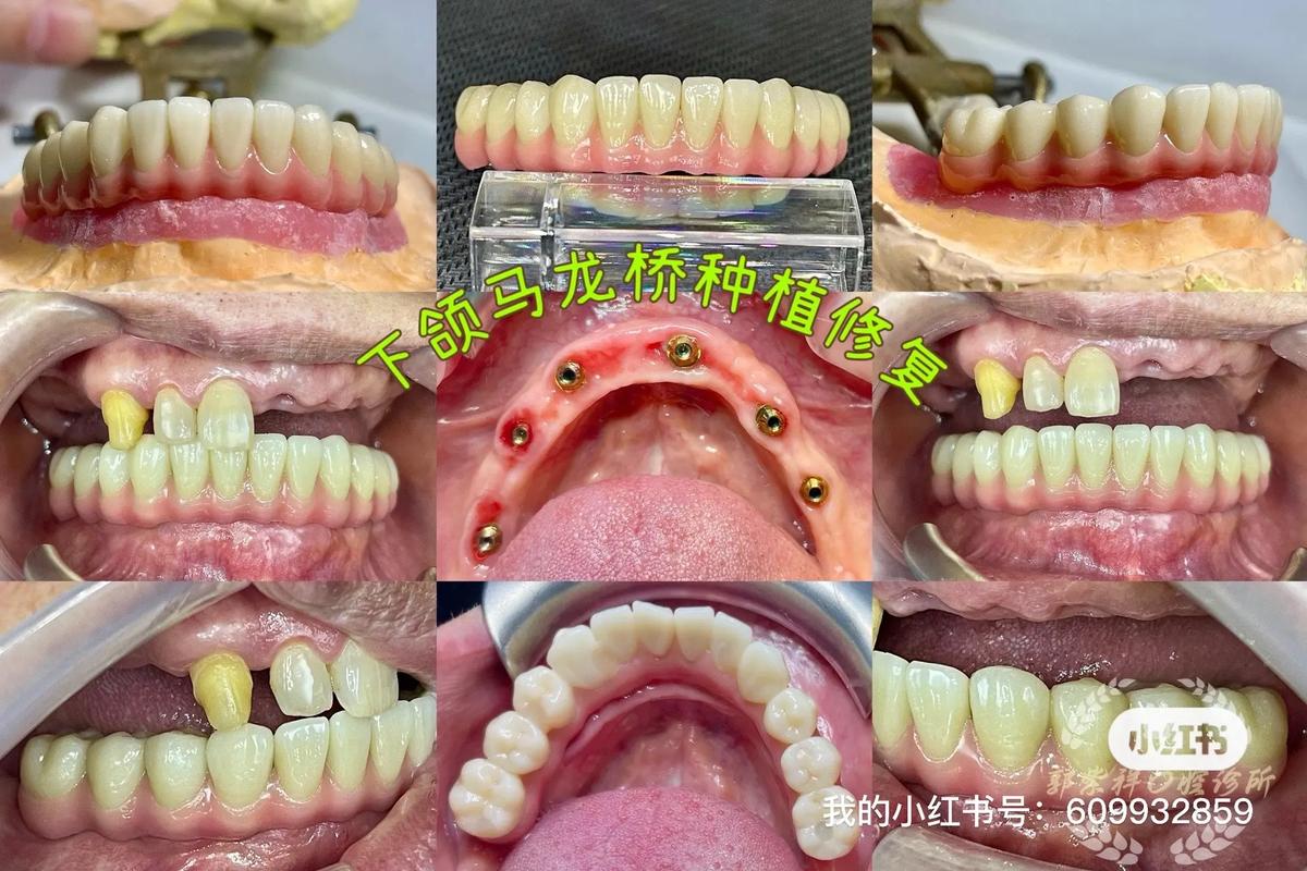 做牙桥好还是种牙好-图1