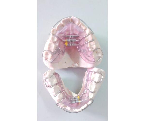 活动矫正器适合哪些牙齿正畸人群？效果和注意事项有哪些？-图1