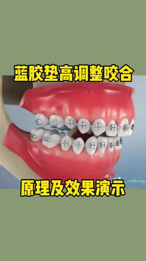 蓝胶如何粘接正畸托槽？操作步骤与技巧详解-图2
