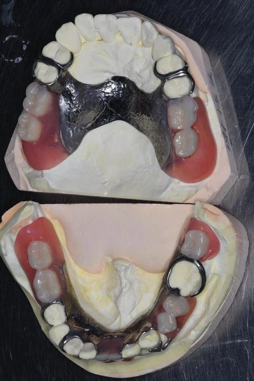 牙外伤导致牙齿松动,临床常用的固定方法有哪些?-图3 牙外伤导致牙齿松动,临床常用的固定方法有哪些?-图3