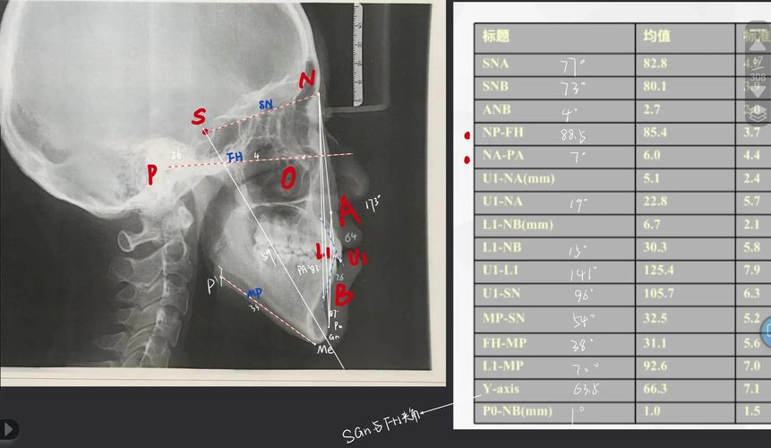 正畸头影测量分析诊断在错颌畸形矫正中起何关键作用?-图2 正畸头影测量分析诊断在错颌畸形矫正中起何关键作用?-图2