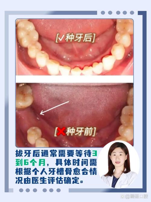 种牙与邻牙间有缝隙，是什么原因导致的？-图3