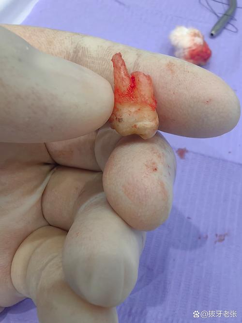 正畸拔左上磨牙的原因是什么？会有哪些影响？-图3