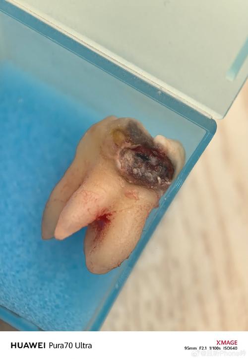 正畸拔左上磨牙的原因是什么？会有哪些影响？-图2