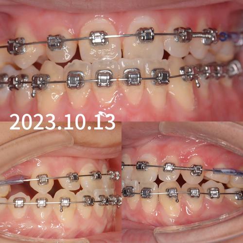 缺牙且伴有龋齿，是否适合进行正畸治疗？-图3