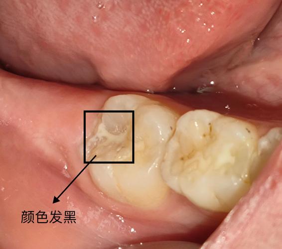 正畸后为何全口牙都蛀了？矫正过程藏隐患？-图1