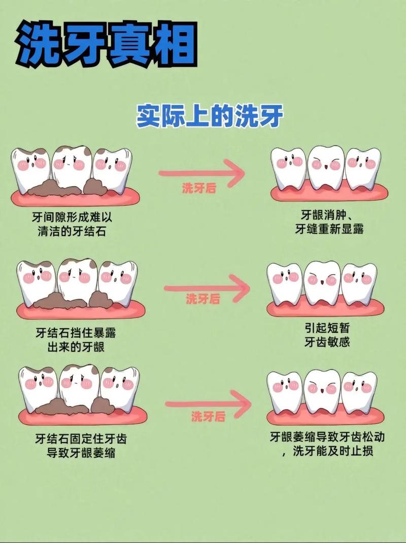种牙前为啥要洗牙？术前口腔清洁对种植成功关键吗？-图3