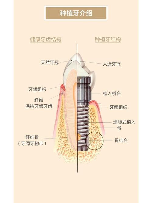 牙槽骨不足能种牙吗?种植牙有哪些应对解决方案?-图1 牙槽骨不足能种牙吗?种植牙有哪些应对解决方案?-图1