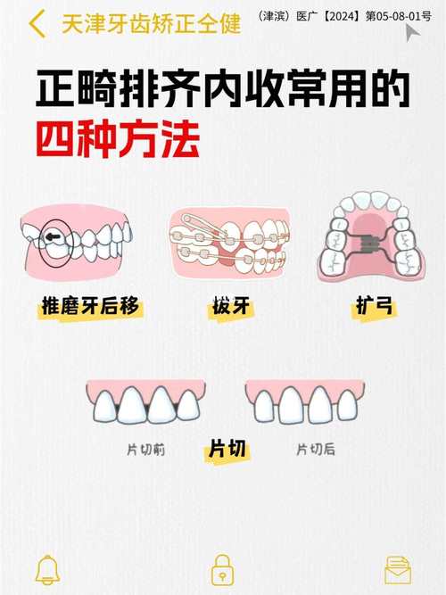 正畸矫正过程中前牙怎样实现有效内收?-图3 正畸矫正过程中前牙怎样实现有效内收?-图3