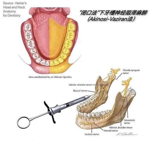 上颌前磨牙麻醉方法的选择依据、操作要点及注意事项有哪些？-图3