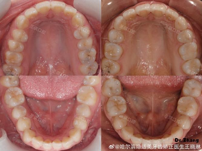 下前牙散在间隙正畸如何矫正？效果能保持多久？-图3