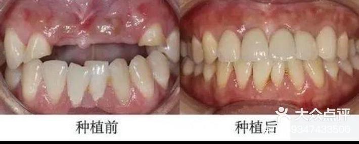 牙槽骨最少高度种牙-图2