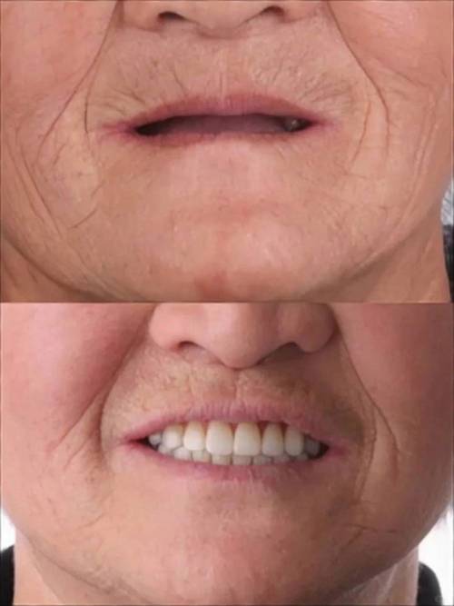 缺牙后牙齿倾斜,种牙前必须先处理倾斜问题吗?-图3 缺牙后牙齿倾斜,种牙前必须先处理倾斜问题吗?-图3