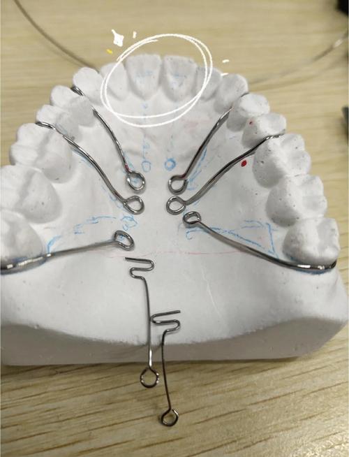 口腔正畸邻间钩的制作-图1 口腔正畸邻间钩的制作-图1