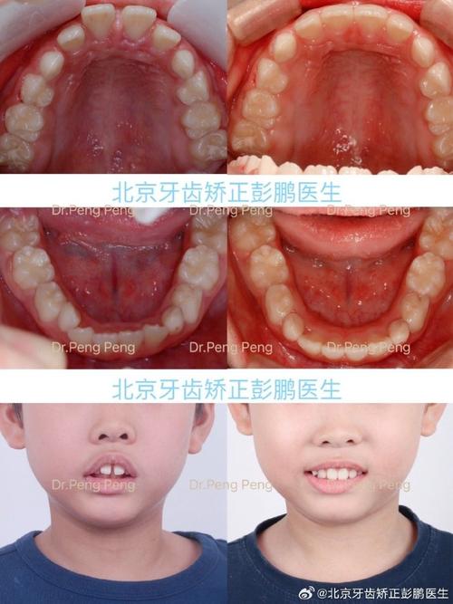 门牙多生牙正畸病例集，多生牙如何影响正畸效果？-图2