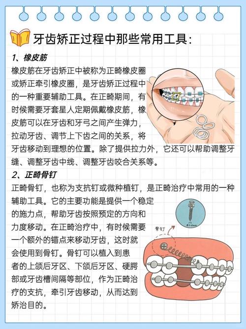 正畸辅助治疗方法有哪些？各自适用于哪些矫正需求？-图2